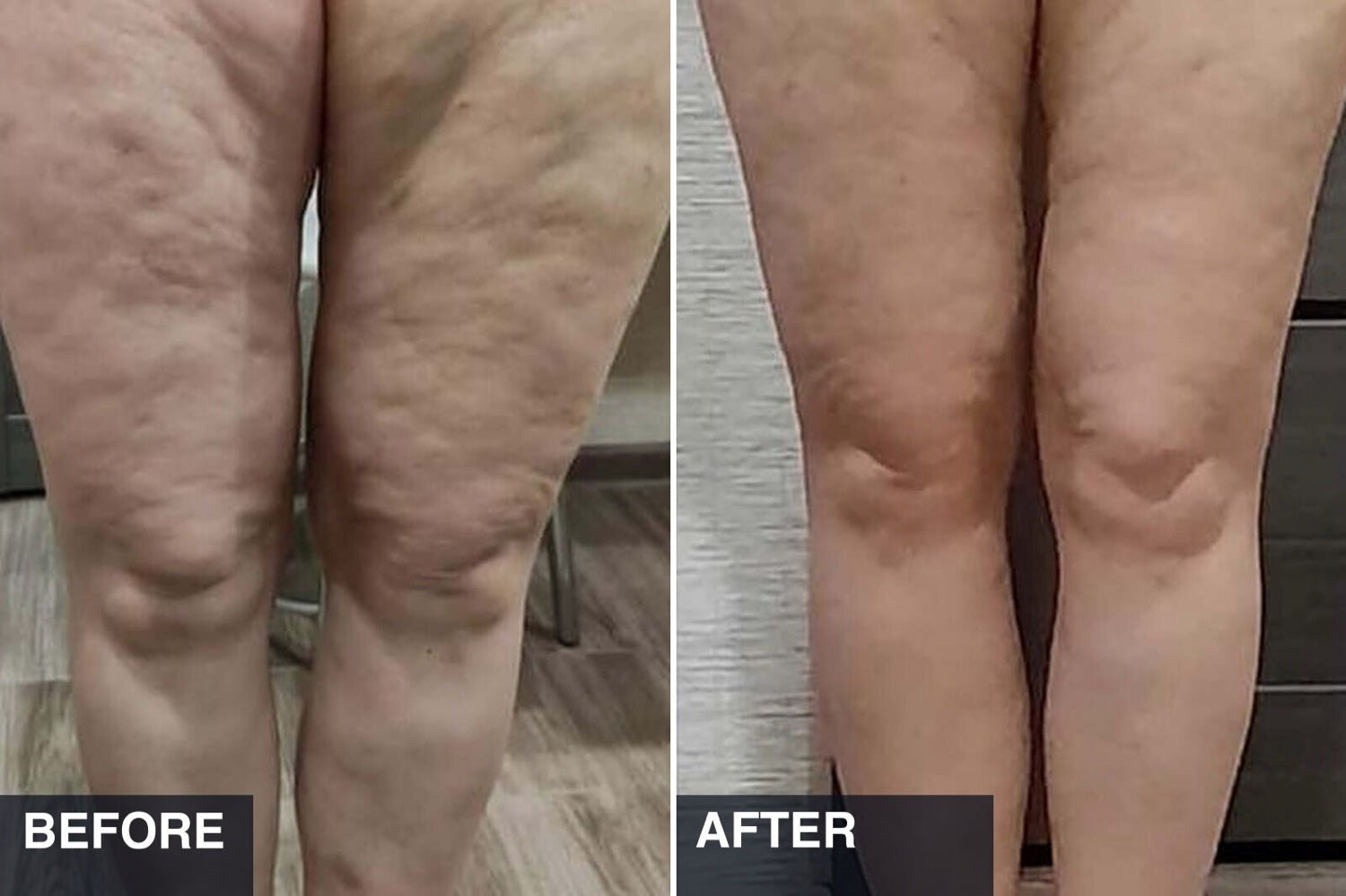 A Night-Shift Nurse Kept Noticing the Same Thing on Women’s Legs — Then She Saw It on Her Own