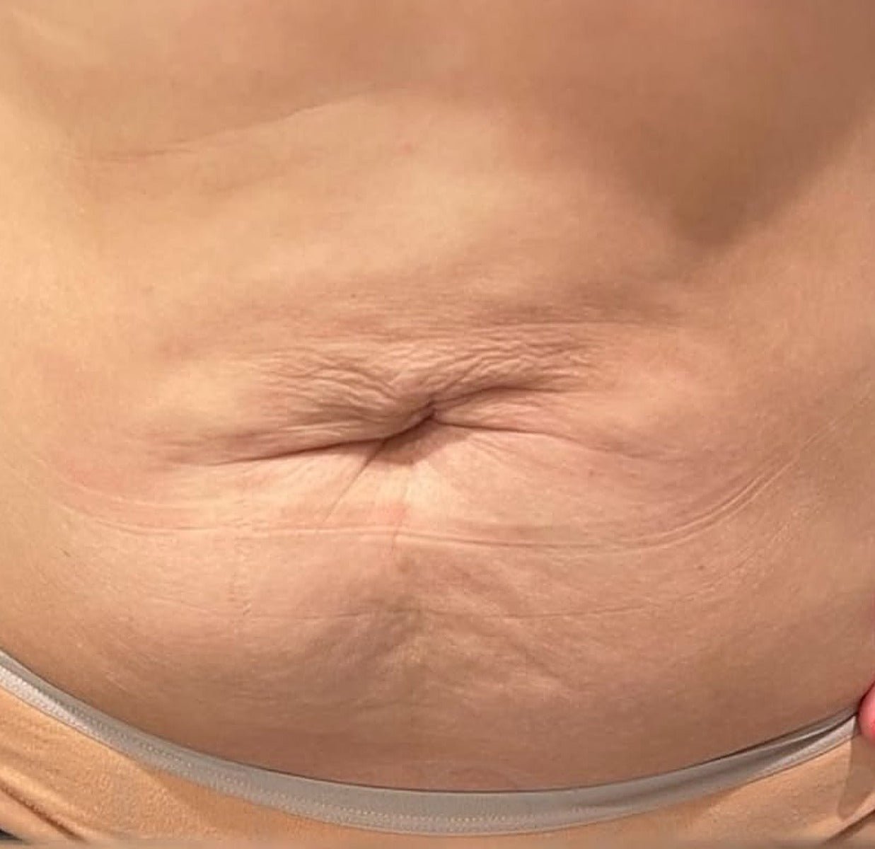 “Post-baby” tummy skin: what actually helped one mum of two